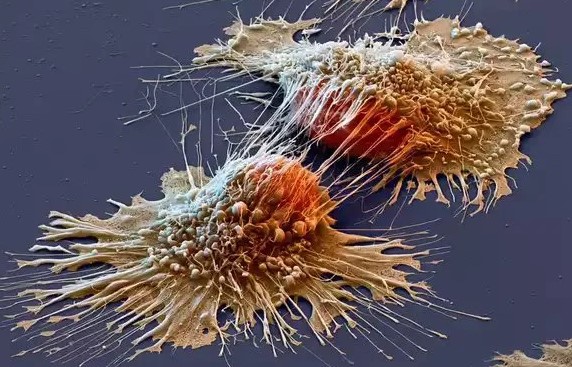 qelize-canceri.jpg
